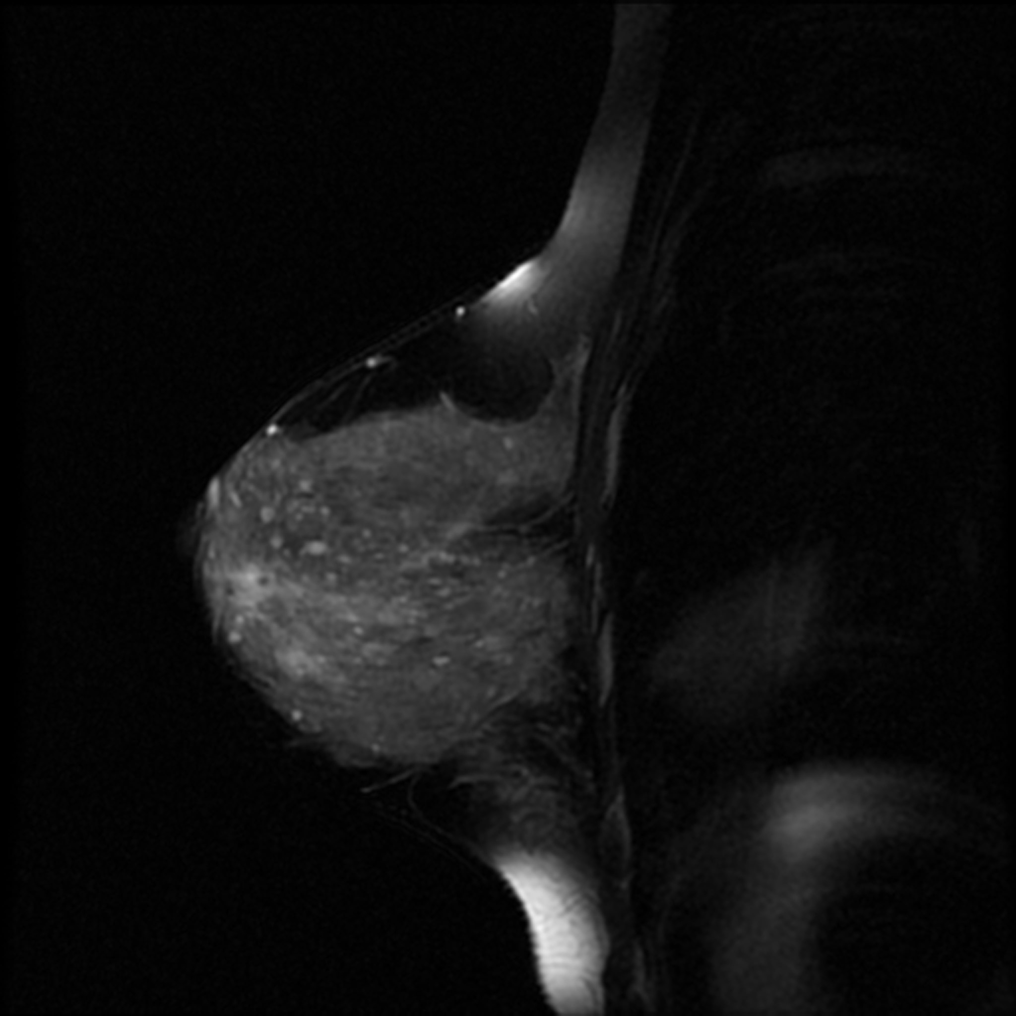 RMN San,rmn mamar,rmn mamar pret,rmn san bilateral,RMN mamar bilateral,RMN san cu substanta de contrast,ecografie mamara,RMN mamar cu substanta de contrast,rmn de san RMN San, biomedscan