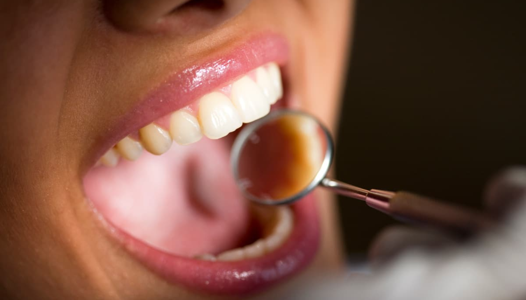 "Tannlege undersøker hvite tenner med speil under en tannhelsekontroll." crohns sykdom behandling av crohns sykdom sykdom er en kronisk kirurgisk behandling sykdom crohns del av tynntarmen ulcerøs kolitt inflammatorisk tarmsykdom nedre del behandling mens andre sykdommen tarmen symptomer pasienter hos betennelse får effekt bør ofte andre brukes del behandlingen kronisk magesmerter crohn viktig legemidler komplikasjoner symptomene diaré gis diagnosen fordøyelseskanalen fistler plager mage derfor alvorlig tynntarmen nødvendig fleste deler kontroll perioder betennelsen enkelte medisiner aktiv mer flere vanligste vekttap tykktarmen lege tarmsykdom hele tid ulike pasienten vedlikeholdsbehandling koloskopi nedre under ganger vanligvis tarm ramme legemiddelbehandling årsaker legen tilfeller mulig barn inflammatorisk bivirkninger vanlig tar