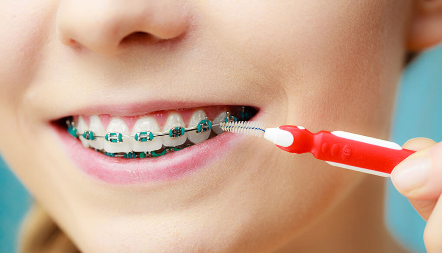 Mellomromsbørste: Det Beste Verktøyet for Renhold Mellom Tennene 15 Nærbilde av person med tannregulering som bruker interdentalbørste for rengjøring mellom tenner og bøyler under daglig munnhygiene hjemme
