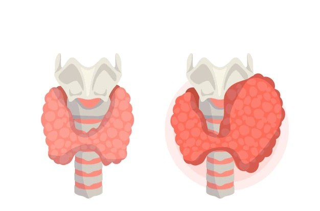 thyroid nodules may be benign nodules or cancer cells 