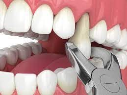 Model showing a tooth extraction