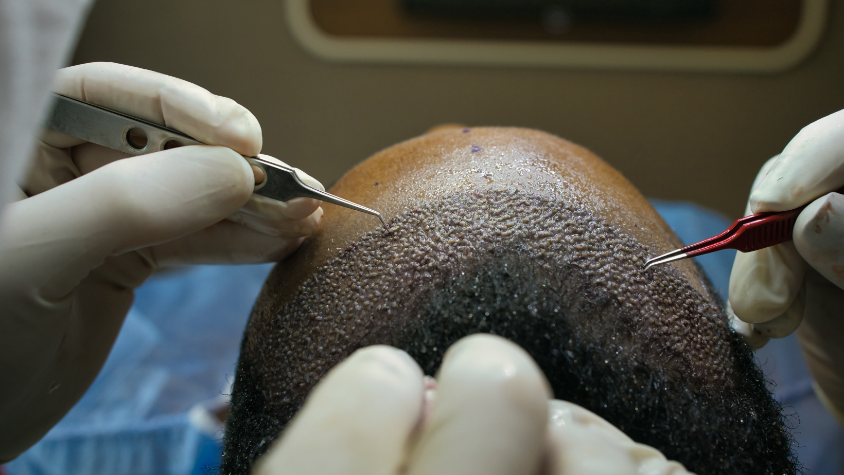 FUE Hair Transplant Process - hair implants near me