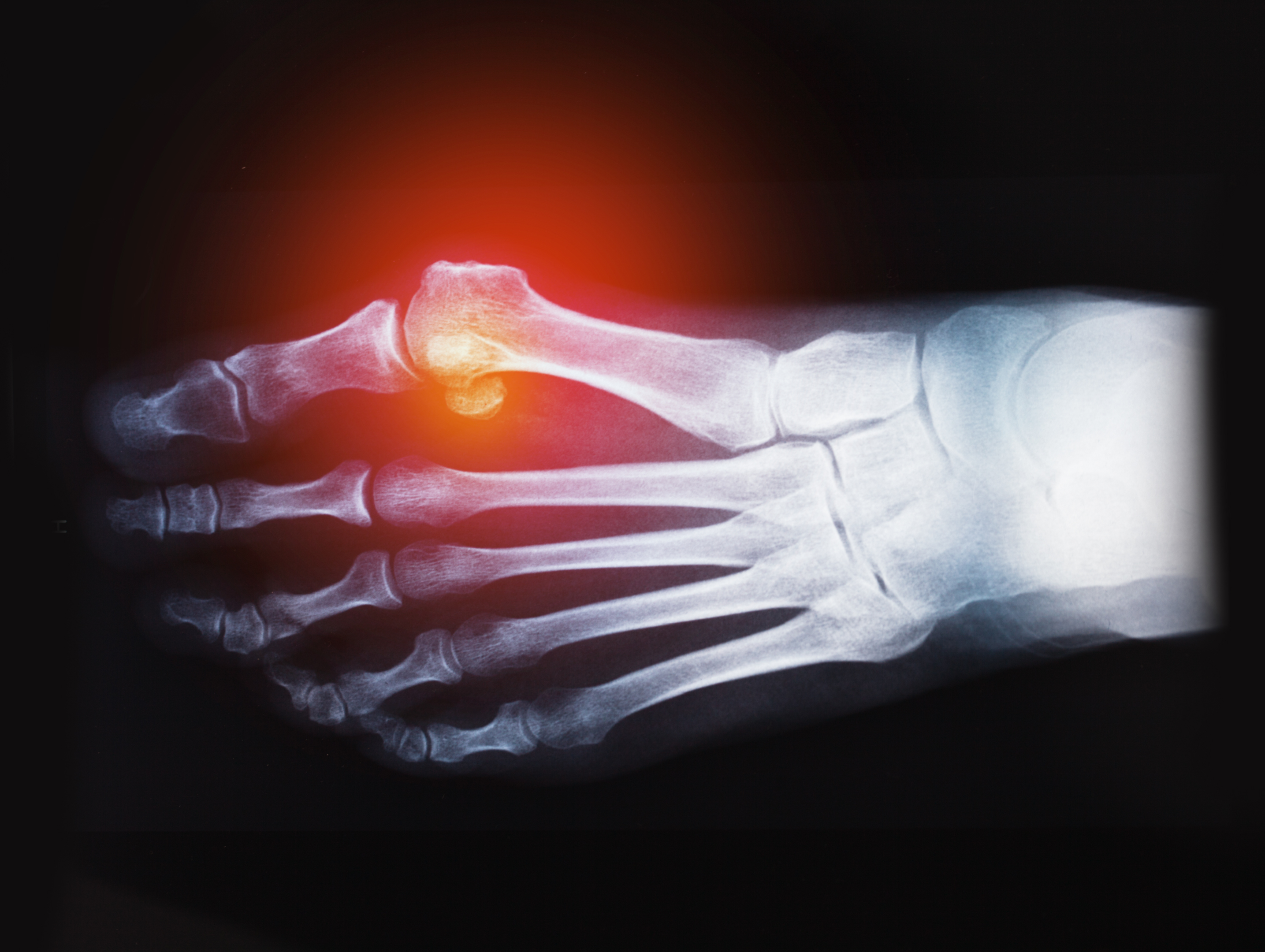 Röntgenbild som visar en fot med hallux valgus efter operationen