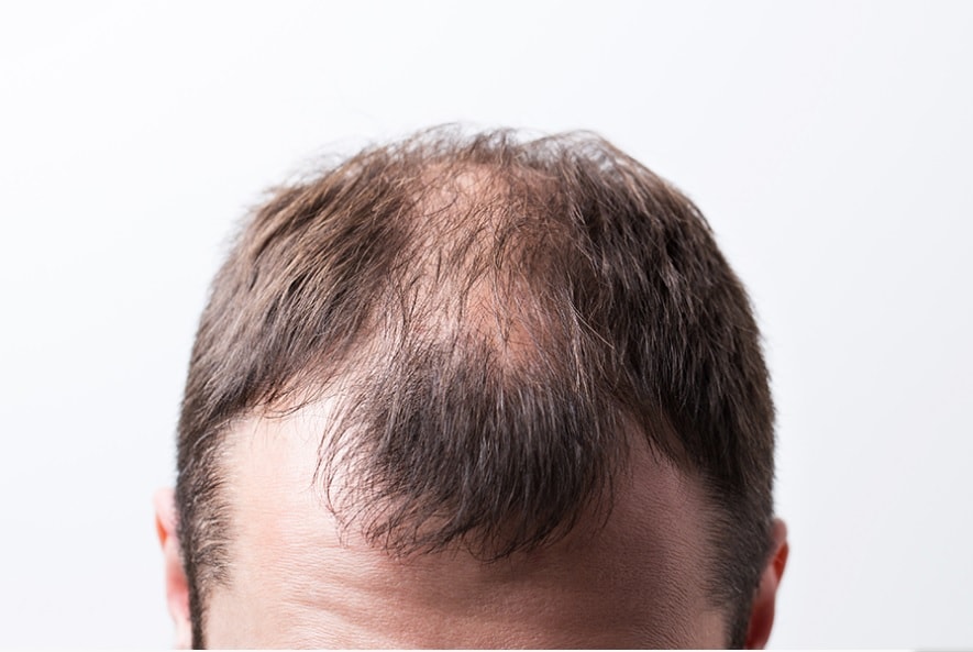 Celulas madre derivadas de Tejido adiposo en alopecia androgenica