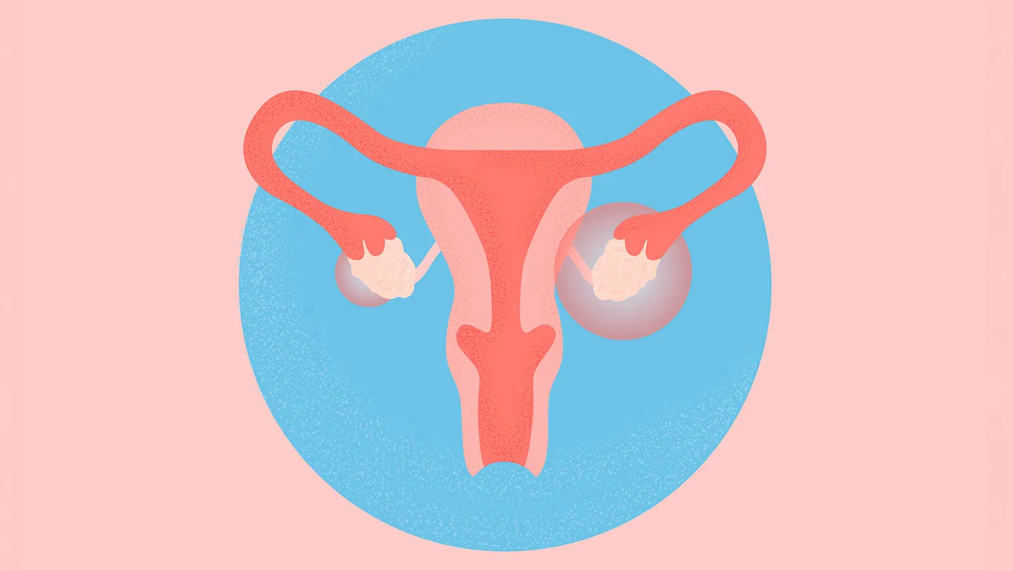What is PCOS, and Why does Diet affect PCOS Symptoms