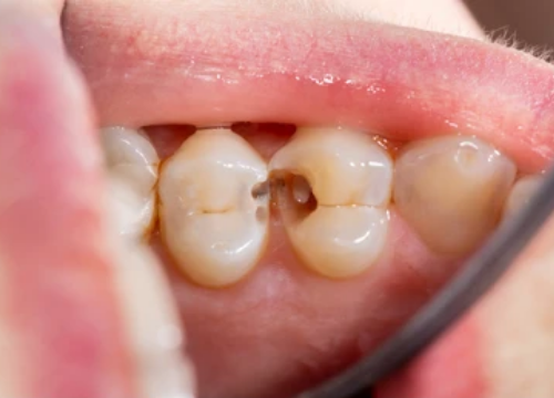 Black Stains on Teeth Causes Remedies and Treatment