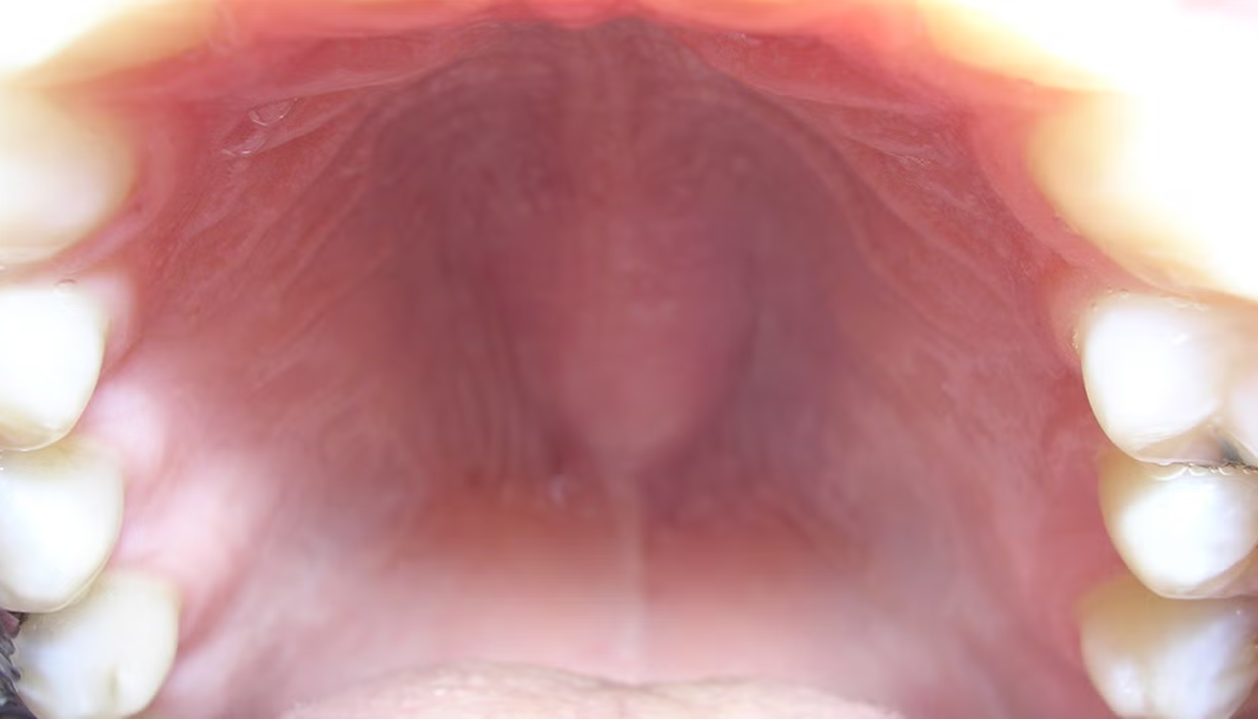 Nærbilde av ganen inne i munnen, med tenner på hver side. Viser slimhinne og struktur i en tilsynelatende frisk munnhule. 