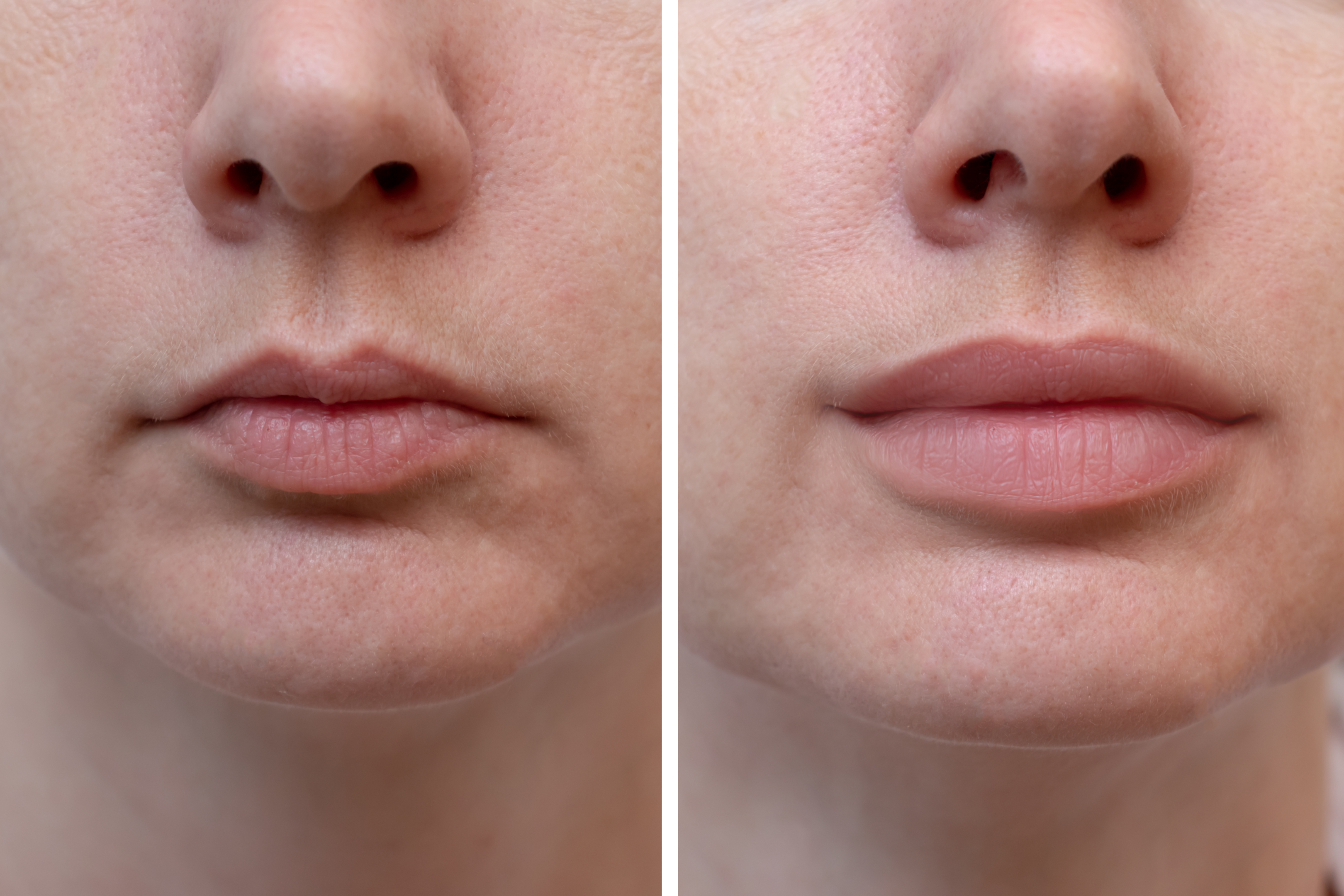 Top 10 Lip Filler Shapes to Enhance Your Natural Beauty – Leva Medical