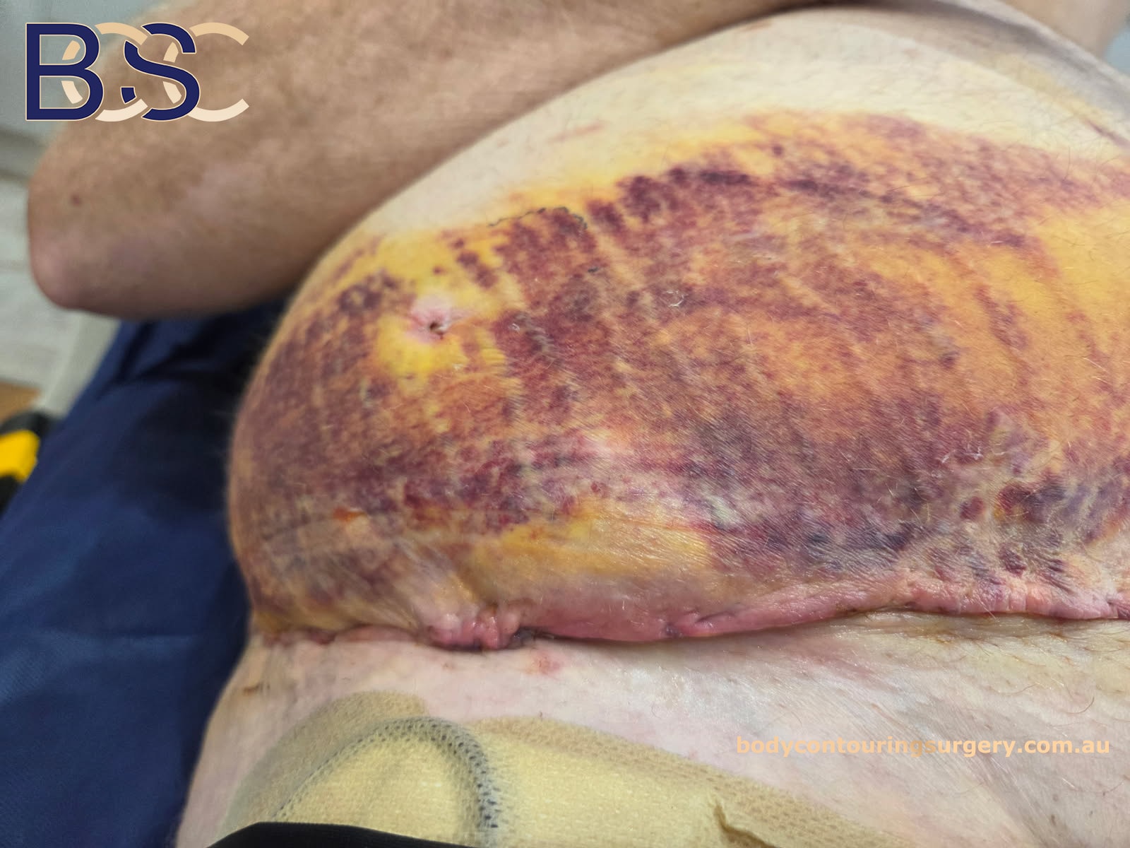 Haematoma post surgery - Lower Trunk Operation Haematoma post surgery - Lower Trunk Operation