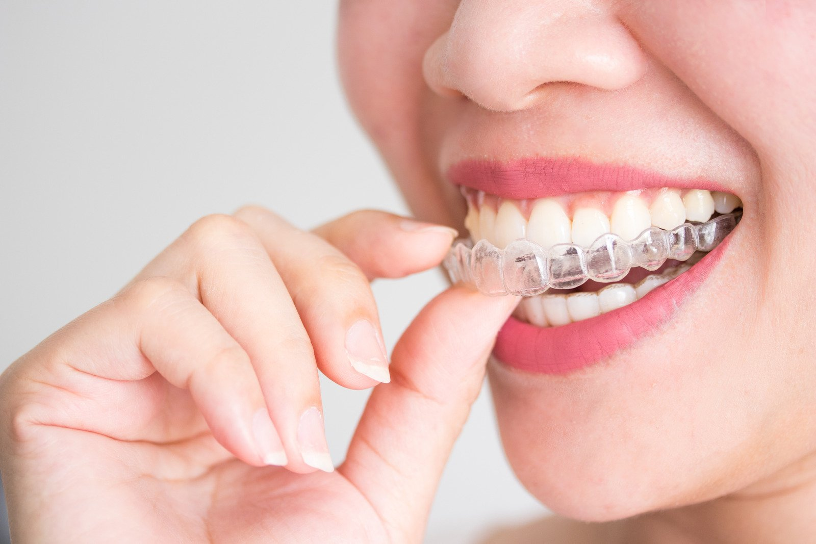 beautiful smile, clear aligners