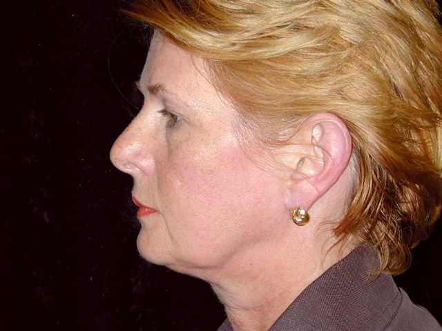 Facelift and Neck lift Surgery Before, a patient in Santa Rosa, CA