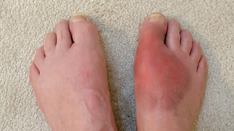 Man kann schwere Gichtanfälle vorbeugen, wenn man sich an strikte Regeln hält