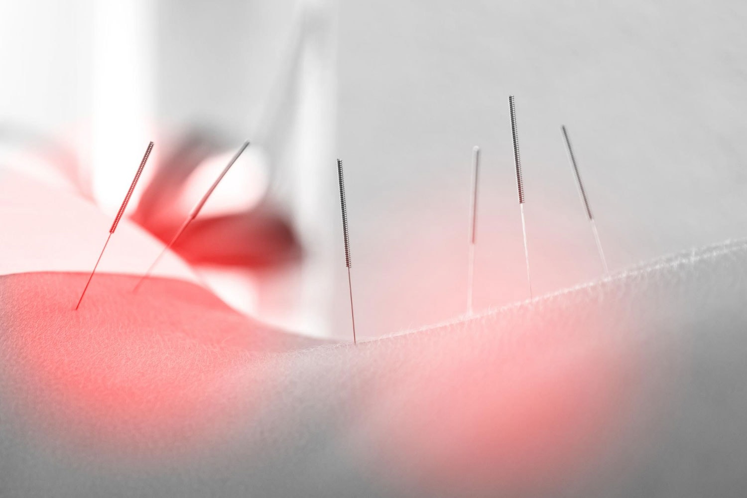 acupuncture-therapy