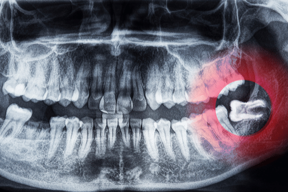 x-ray of impacted wisdom tooth