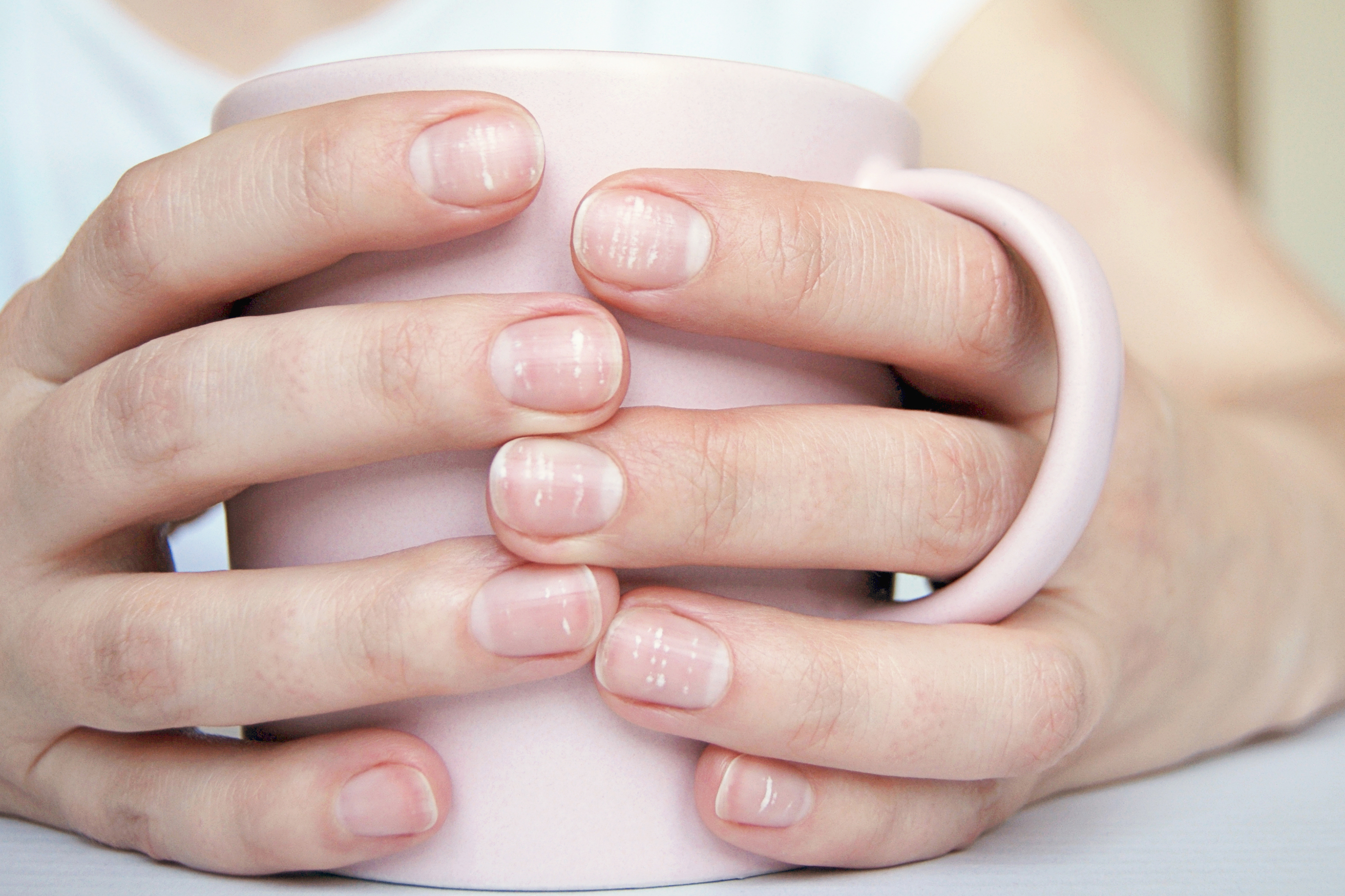 A person having white spots on both hands.