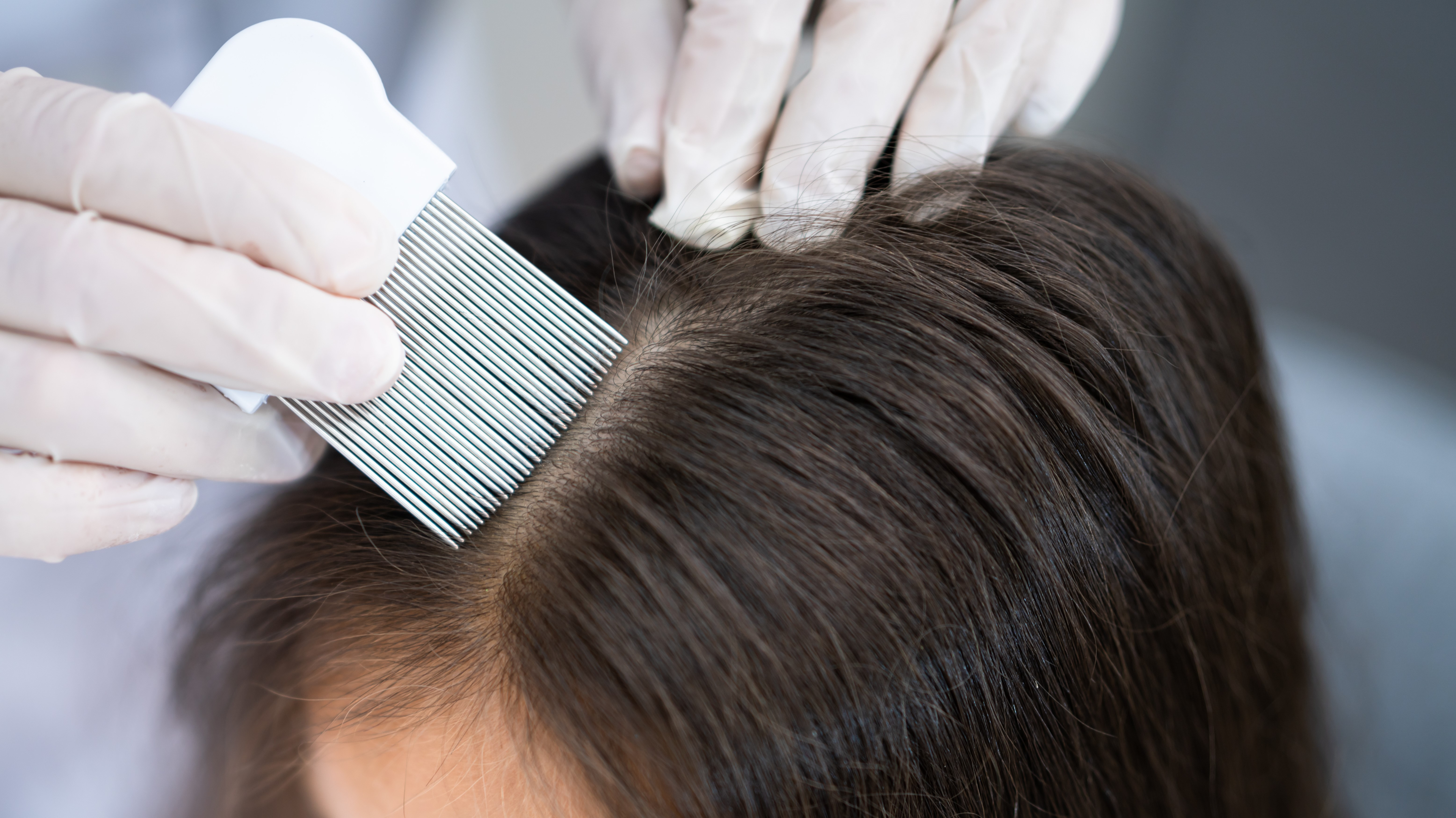 microneedling and dermarolling on scalp for women with thinning hairs