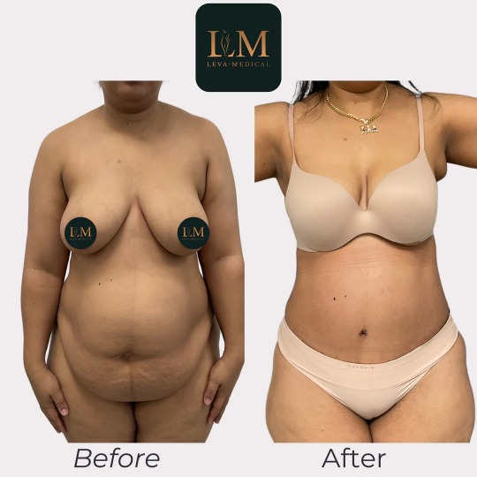 Una imagen del abdomen de una persona antes y después de una cirugía de abdominoplastia completa.