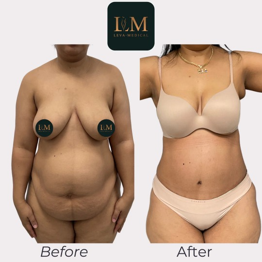 Abdominoplastia: Todo lo que necesitas saber - Clínica Centromed