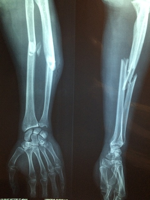 fracture bone, xray, skeleton