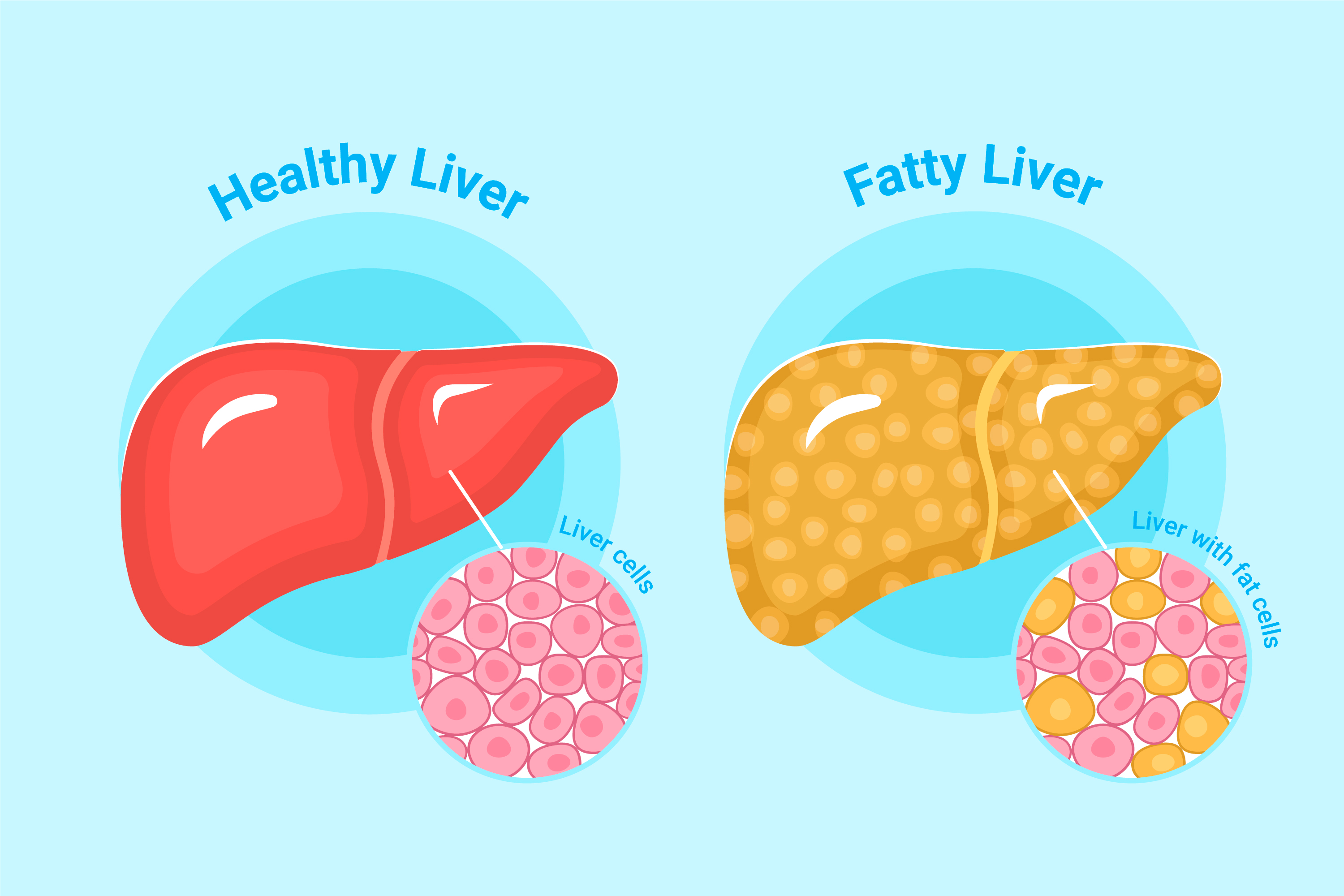 Liver damage due to fatty foods