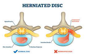 Herniated Disc Images – Browse 4,524 Stock Photos, Vectors, and Video |  Adobe Stock