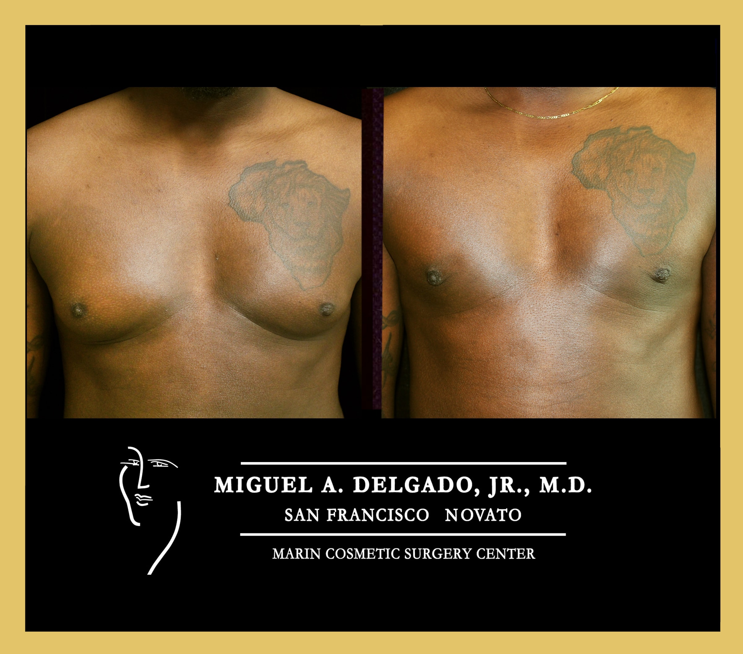 A patient after minimal invasive gynecomastia surgery.