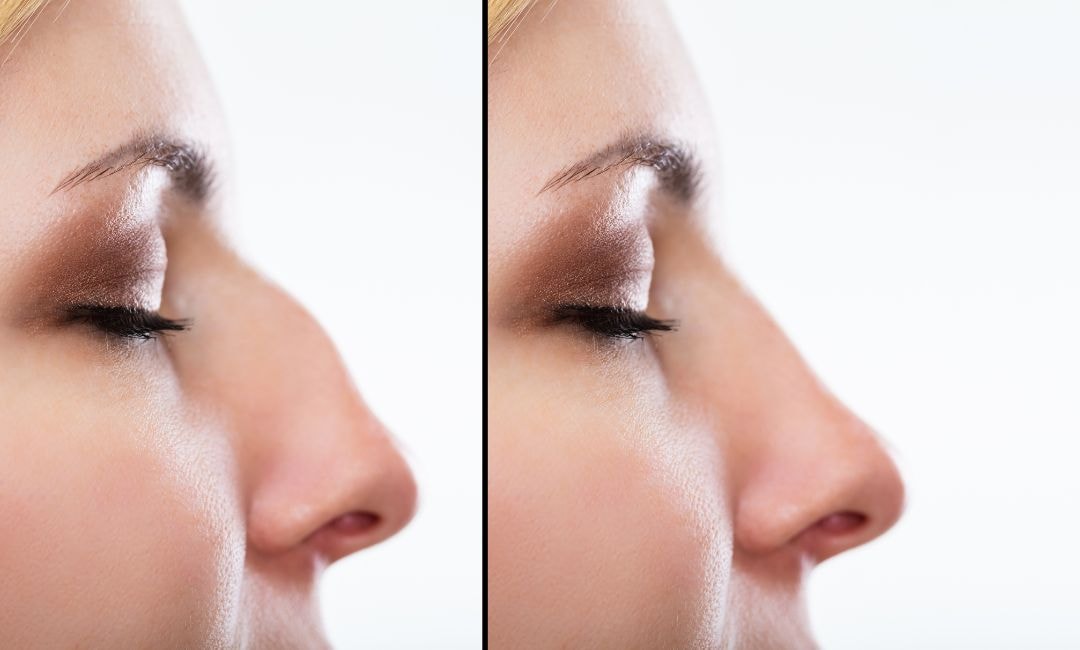 facial plastic surgery