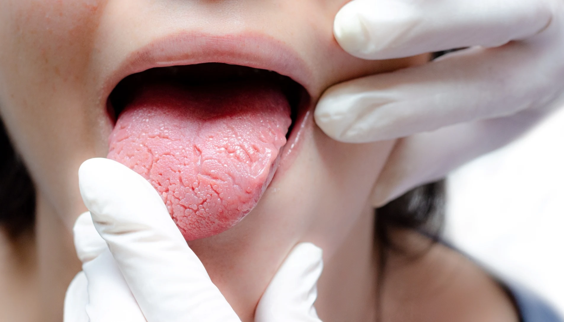 Tannlege med hansker undersøker pasientens tunge nøye, viser tydelige sprekker og ujevn overflate.