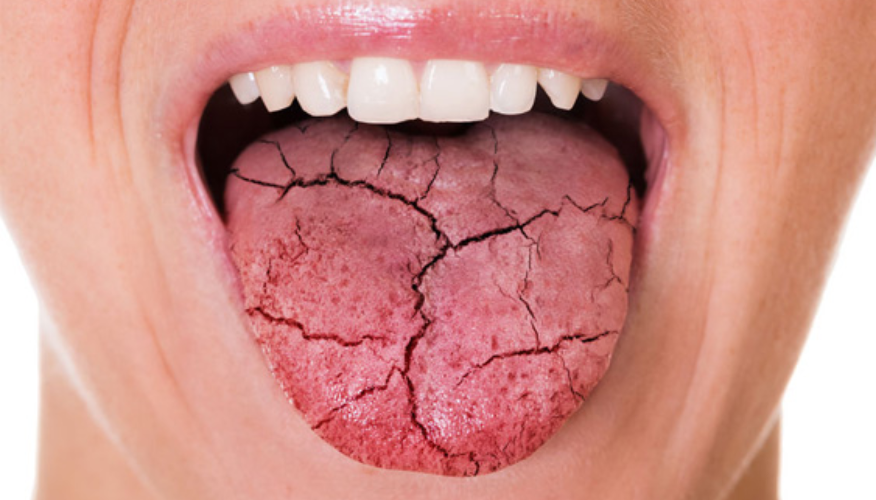  "Nærbilde av en munn med svært tørr og sprukken tunge som viser tydelige sprekker og dehydreringstegn." sjøgrens syndrom primært sjøgrens syndrom sekundært sjøgrens syndrom tørre øyne syndrom er en kronisk andre revmatiske sykdommer revmatiske sykdommer tørr munn sjøgrens sykdom syndrom sjøgrens revmatisk sykdom nedsatt tåre og spyttproduksjon blant annet først og fremst tørre slimhinner revmatoid artritt får diagnosen systemisk lupus autoimmun sykdom indre organer kronisk betennelse tørr skjede øker risikoen behandling hos andre øyne symptomer tørr munn sykdommen tørrhet får betennelse bør kvinner spyttkjertler ofte pasienter ssa bruk kronisk nedsatt diagnosen autoimmun barn eksempel brukes kjertler sjelden mer finnes viktig tillegg vanlig ledd systemisk plagene vanligvis gir fleste artritt immunforsvaret funn kroppens lupus rammer fatigue smerter rammes informasjon anti tegn symptomene slimhinner norsk ssb oppstår angriper tretthet