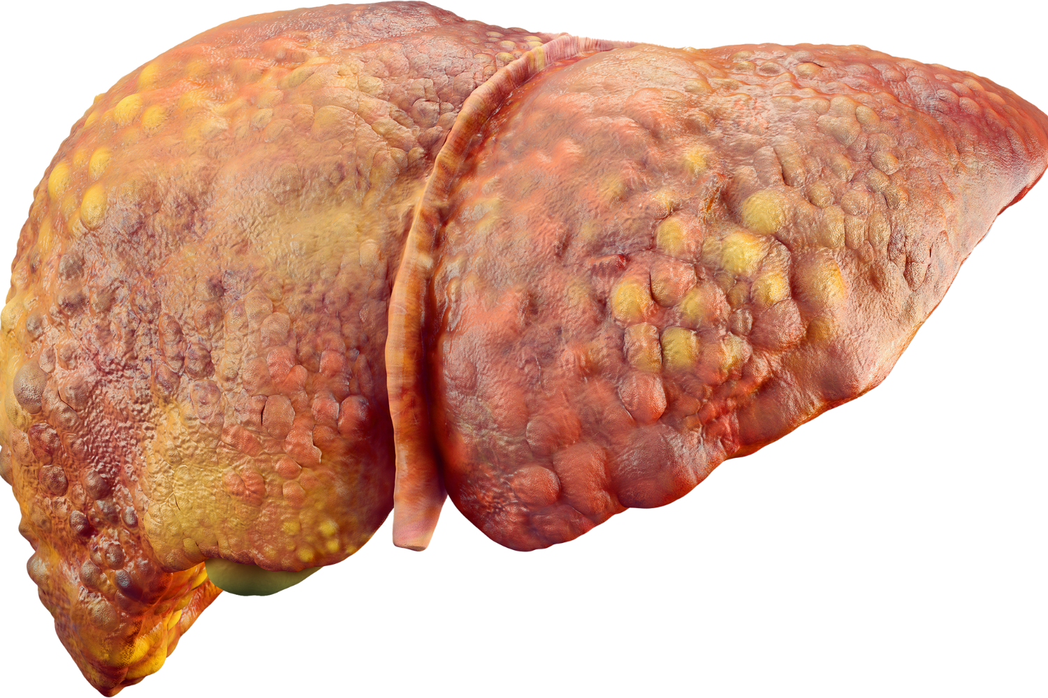 Image of liver cirrhosis.