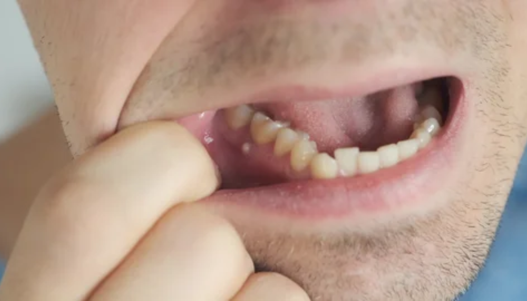 Voksen mann viser hevelse og infeksjon i tannkjøttet bak i munnen.