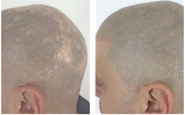 alopecia before and after