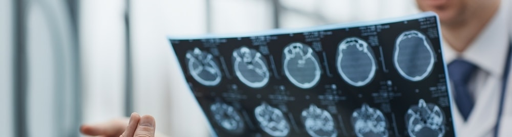 A brain injury lawsuit with head injuries, severe traumatic brain injury, traumatic brain injury compensation, non economic damages, and other factors determine settlement amounts. 