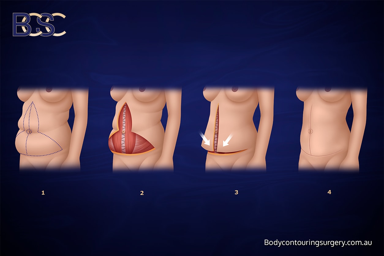 Fleur-de-Lis Abdominoplasty Fleur-de-Lis Abdominoplasty