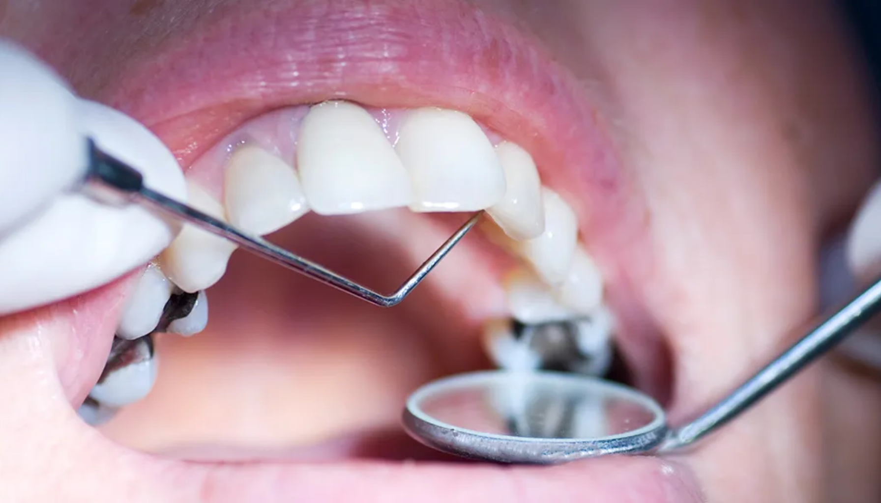 Vondt i Tann Etter Boring? Det Skal Ikke Være Slik 11 Nærbilde av tannlegeundersøkelse med speil og tannpirker som sjekker mellomrom mellom tennene for hull eller tannstein.
