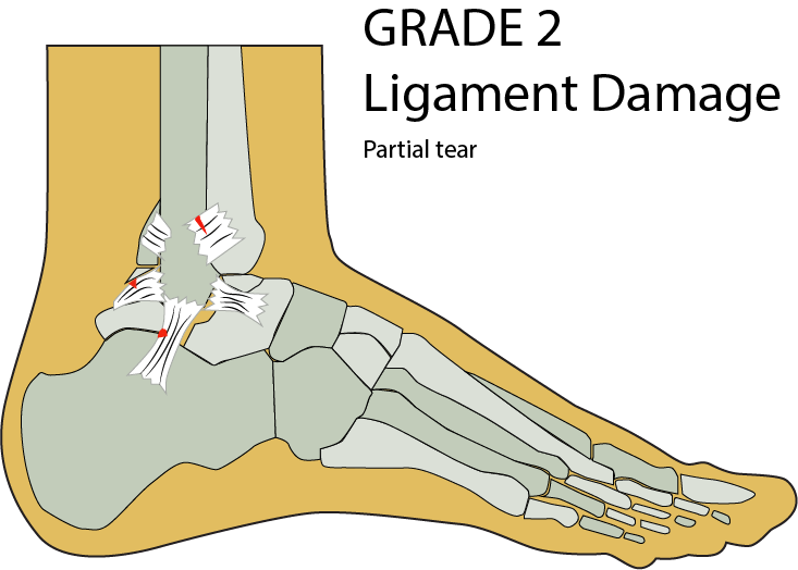 image ligament damage grade 2