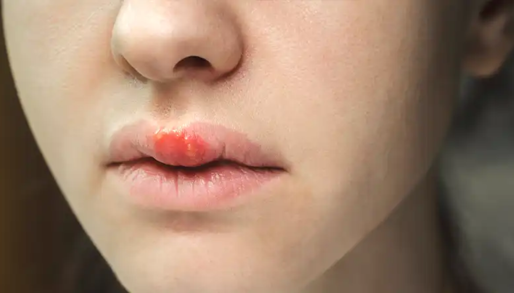 L-lysin: Kosttilskuddet som hjelper mot munnsår 15 "Leppesår på overleppen med rødhet og hevelse, typisk symptom på herpesutbrudd."