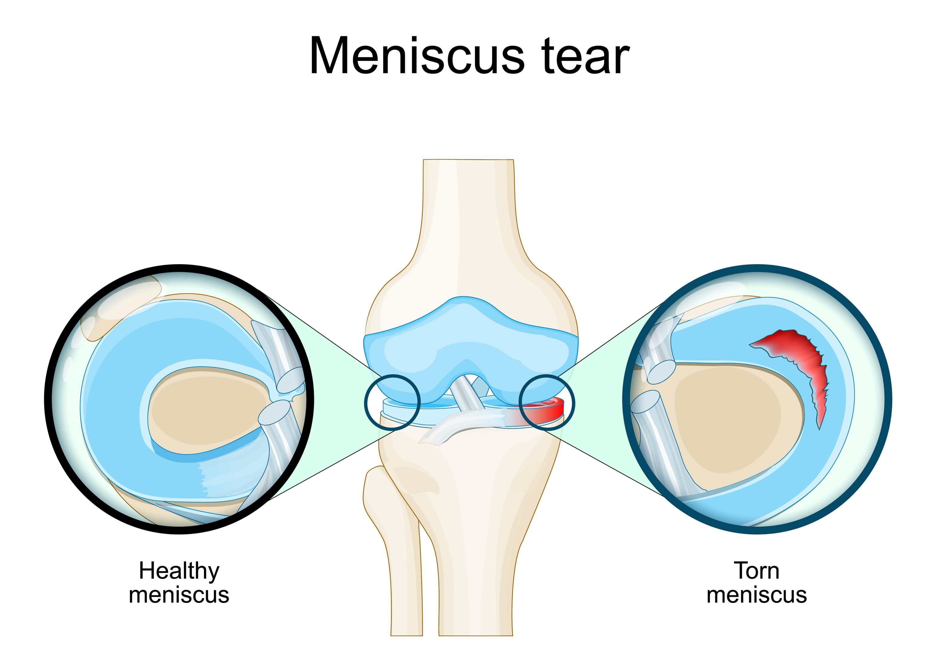 Meniscal Surgery
