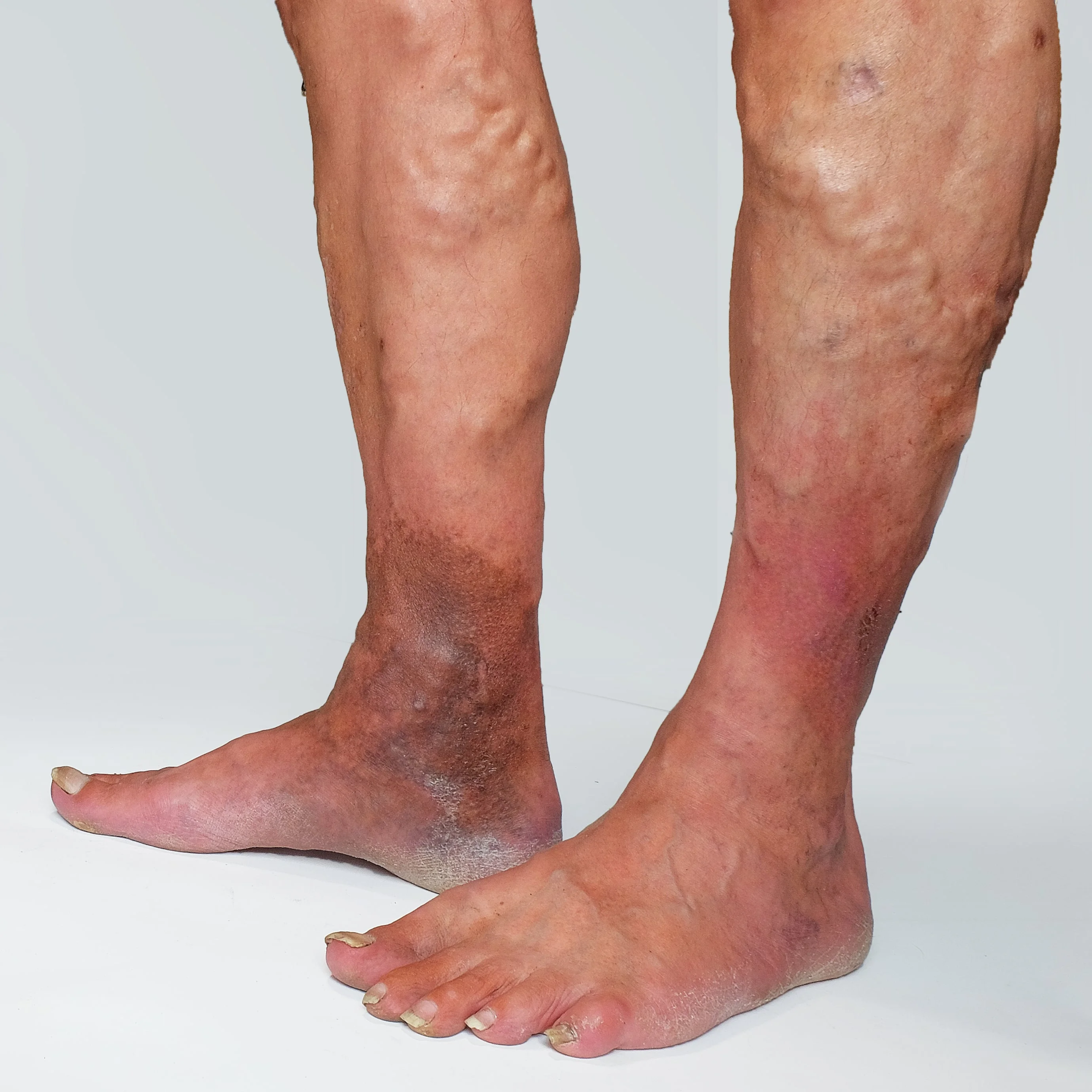 leg of a man presenting advanced chronic venous disease with skin discolouration