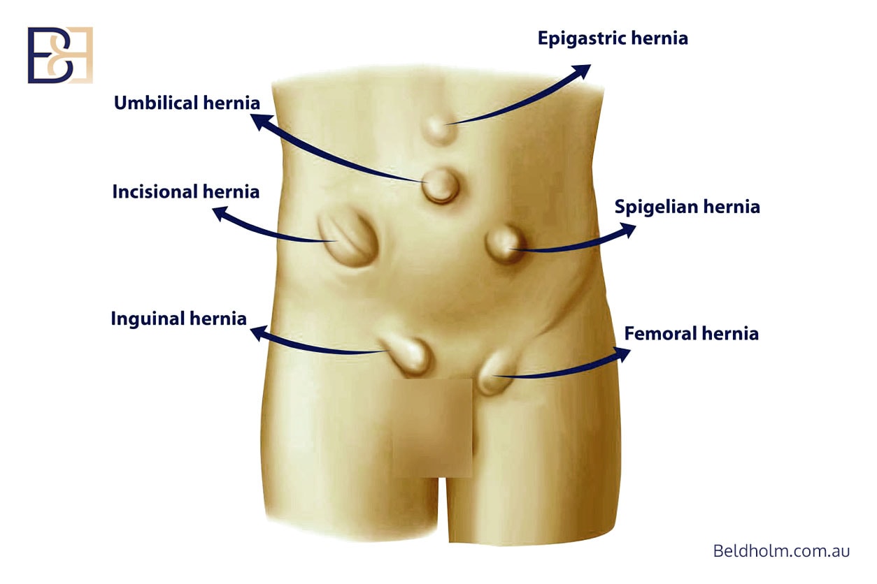 Abdominal wall hernias