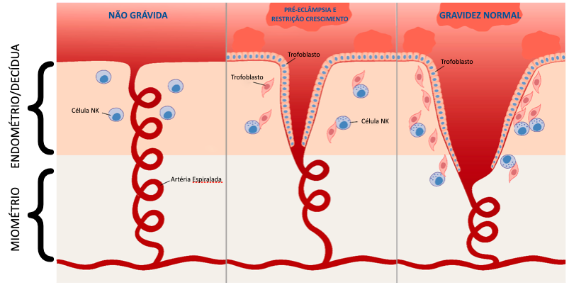Invasão do Trofoblasto em Gestação Normal versus Pré-Eclâmpsia ou Restrição de crescimento.