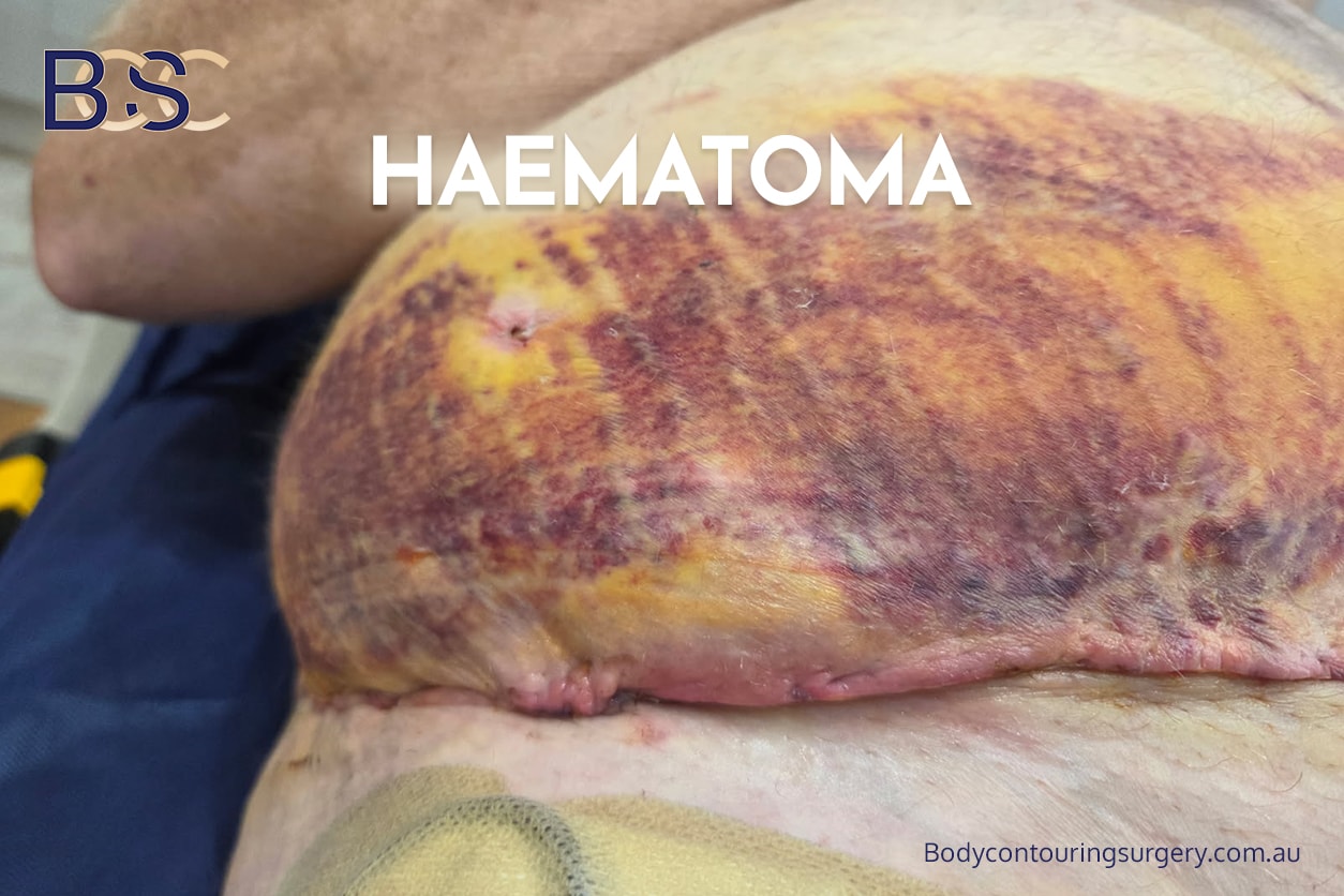 Haematoma post abdominoplasty | Body Contouring Surgery Clinic