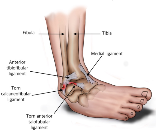 An inversion injury of the ankle displaying the ligaments that may be injured as well as the typical mechanism of injury.