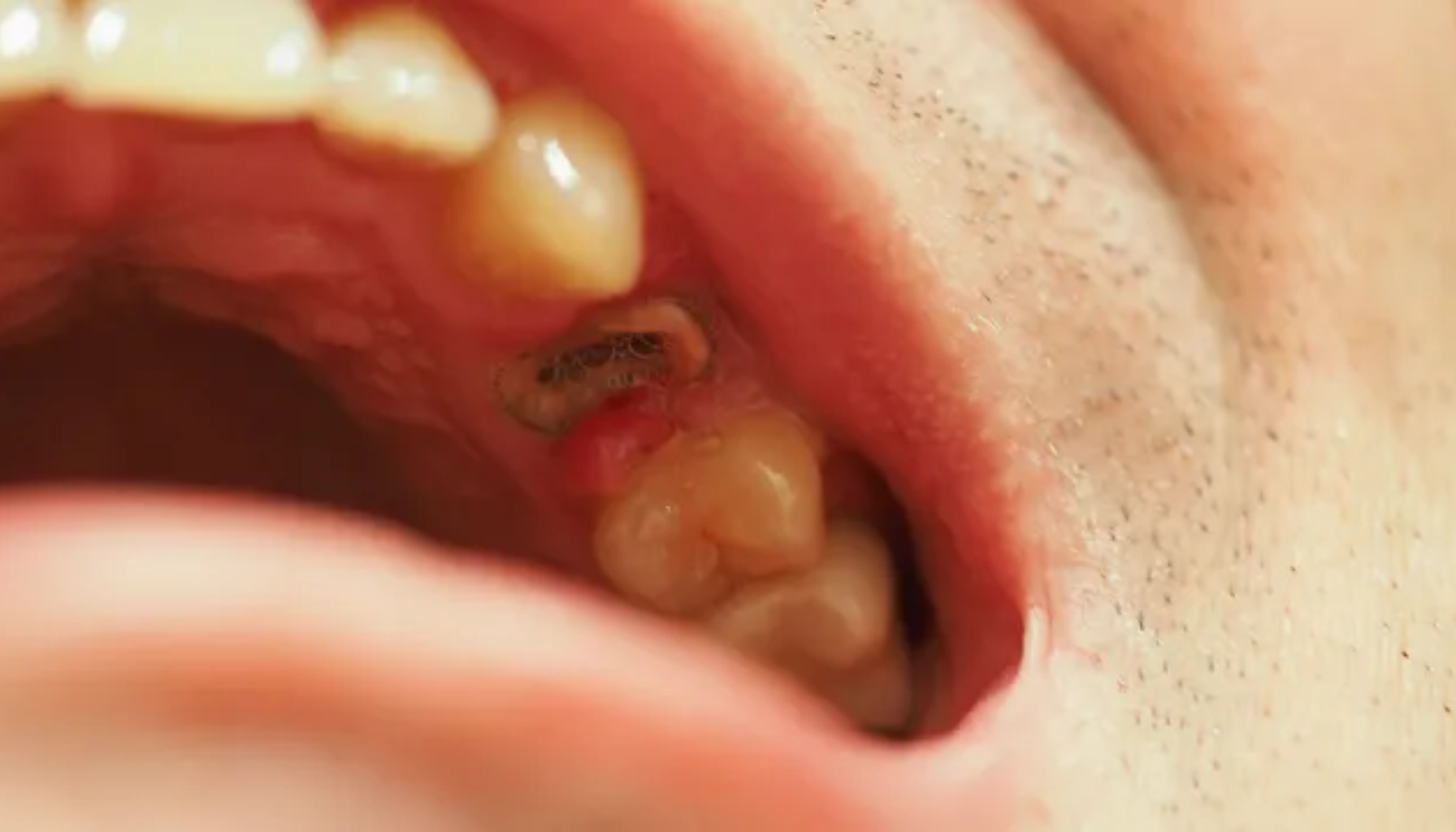 Nærbilde av tanninfeksjon i øvre jekselområde med synlig betennelse, hulrom og tannråte. Viser behov for akutt tannbehandling og dårlig munnhygiene.