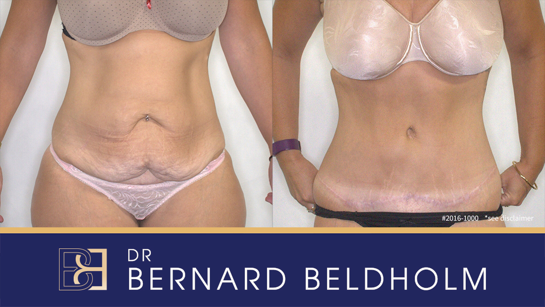 Abdominoplasty after bariatric surgery