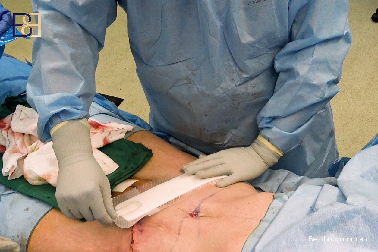 Recovering from Dual-Vector Abdominoplasty 6 Dr Bernard Beldholm applying PICO dressing
