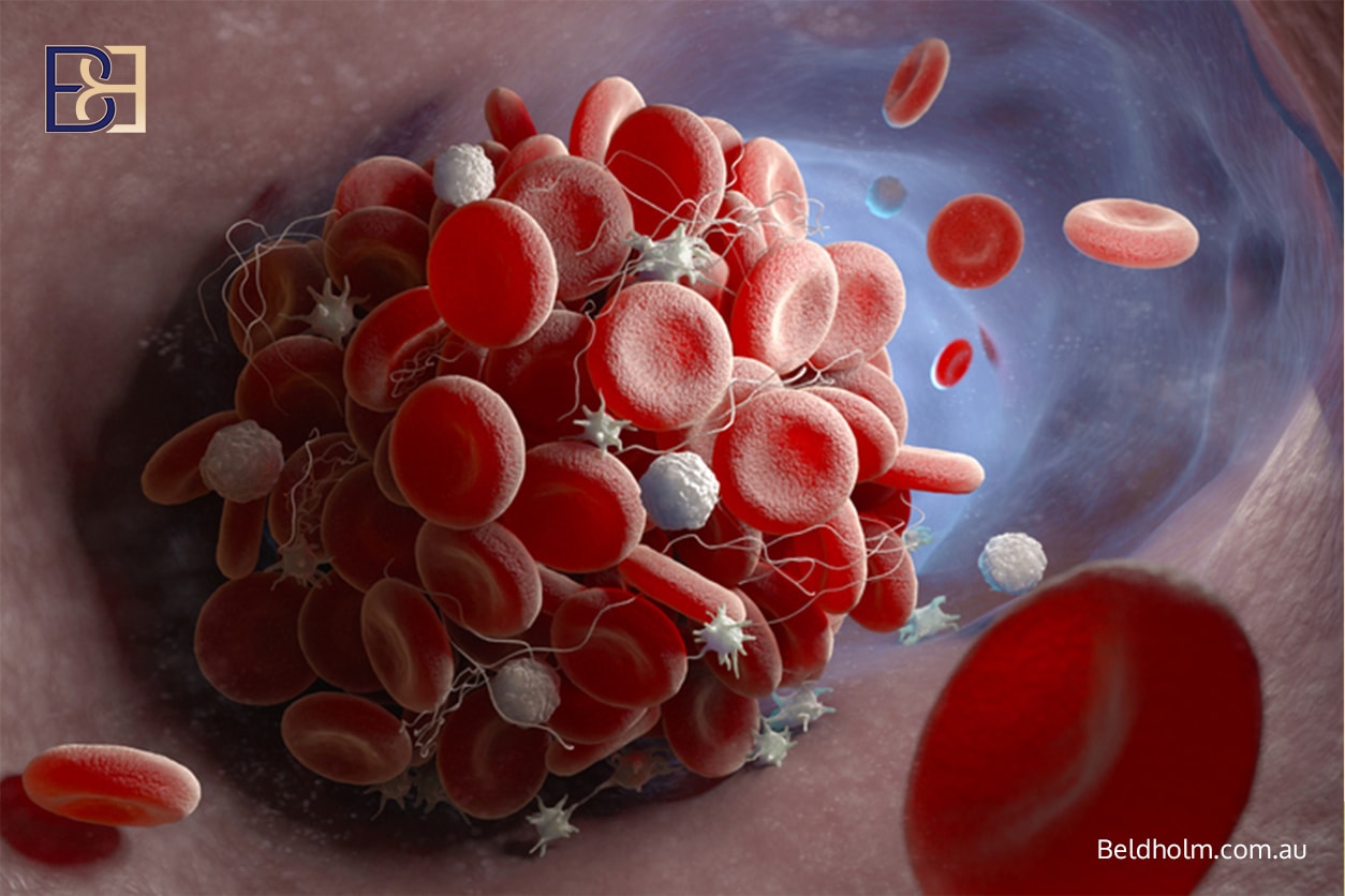 Blood clot