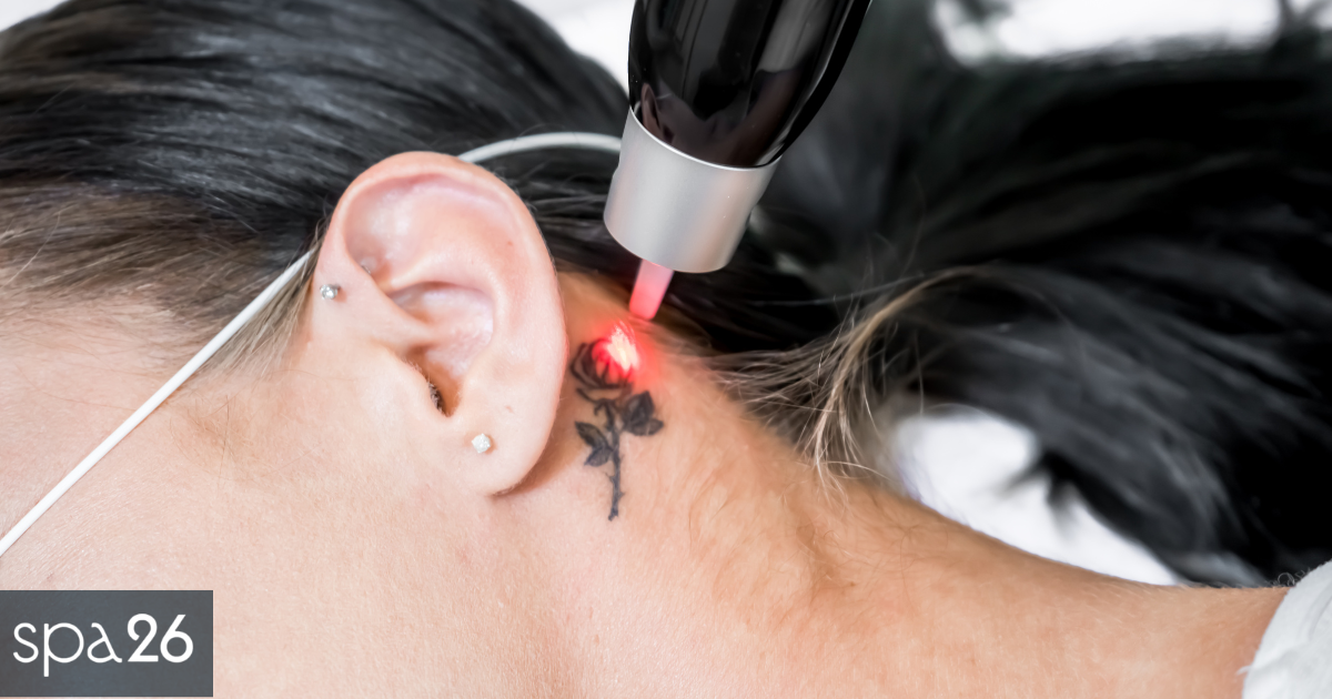 What Is Laser Tattoo Removal and How Does It Work?