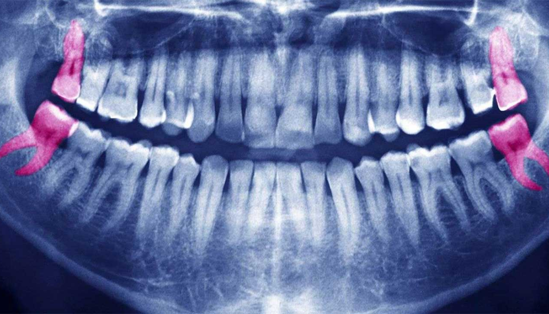 Panoramarøntgen som viser fire retinerte visdomstenner i rosa, liggende skjevt og pressende mot nabotenner i kjeven. retinert visdomstann bryter frem under tannkjøttet retinerte visdomstenner helt frem hos tannlegen fjerne visdomstann retinert tann rundt tannen visdomstann andre tenner tenner visdomstenner tannen retinerte brutt frem retinert frem tannkjøttet problemer visdomstennene fjerne fjerning behandling smerter under helt delvis bryter tann tannlegen komplikasjoner tennene ofte hevelse tilfeller andre hos behandlingen munnen visdomstannen kirurgisk dersom får rundt bør skjer skade symptomer smerte tidlig tannlege infeksjon nødvendig flere inngrepet underkjeven fjernes kommer pasienten operasjonen tegn oftest feil tid spesielt mer betennelse normalt sykdom gjør års plass viktig posisjon mens føre siste time vanligste