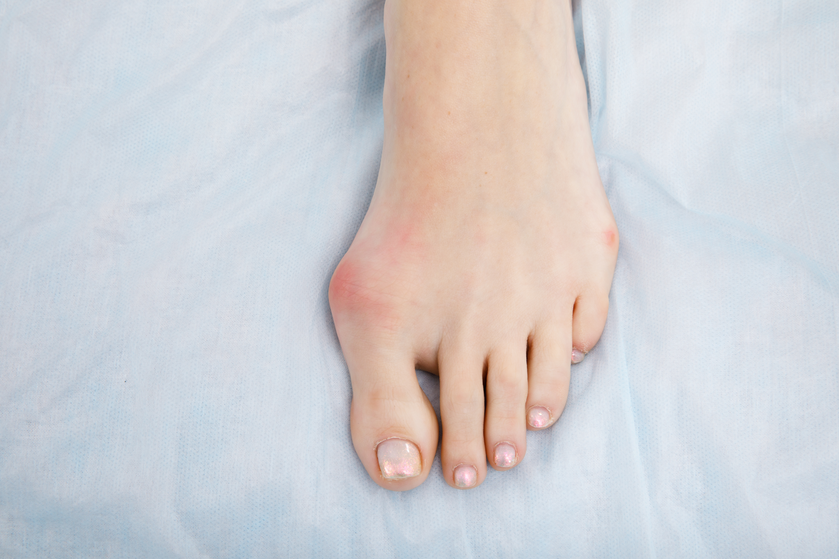 Kvinnofot med hallux valgus före operation